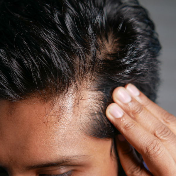 Mens Hair Restoration Charleston